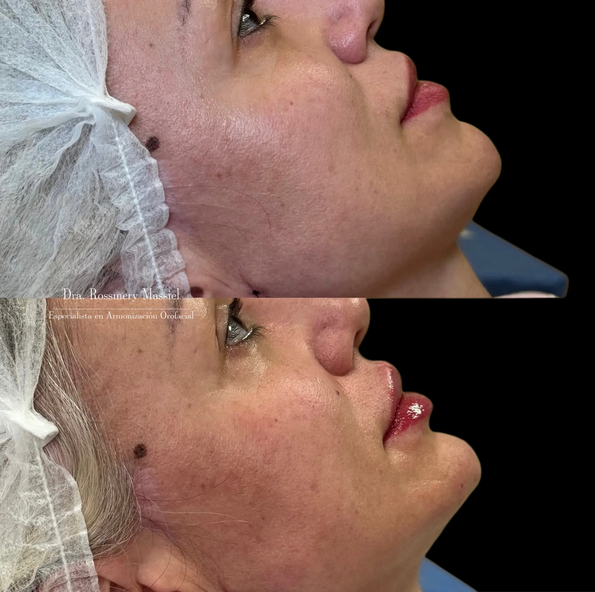 Fotografía clínica comparativa de proyección del mentón dentro de una armonización facial