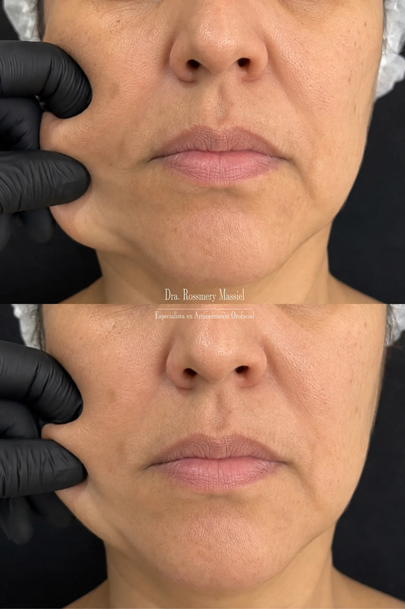 Fotografía clínica comparativa de un tratamiento con bioestimulador de colágeno Sculptra