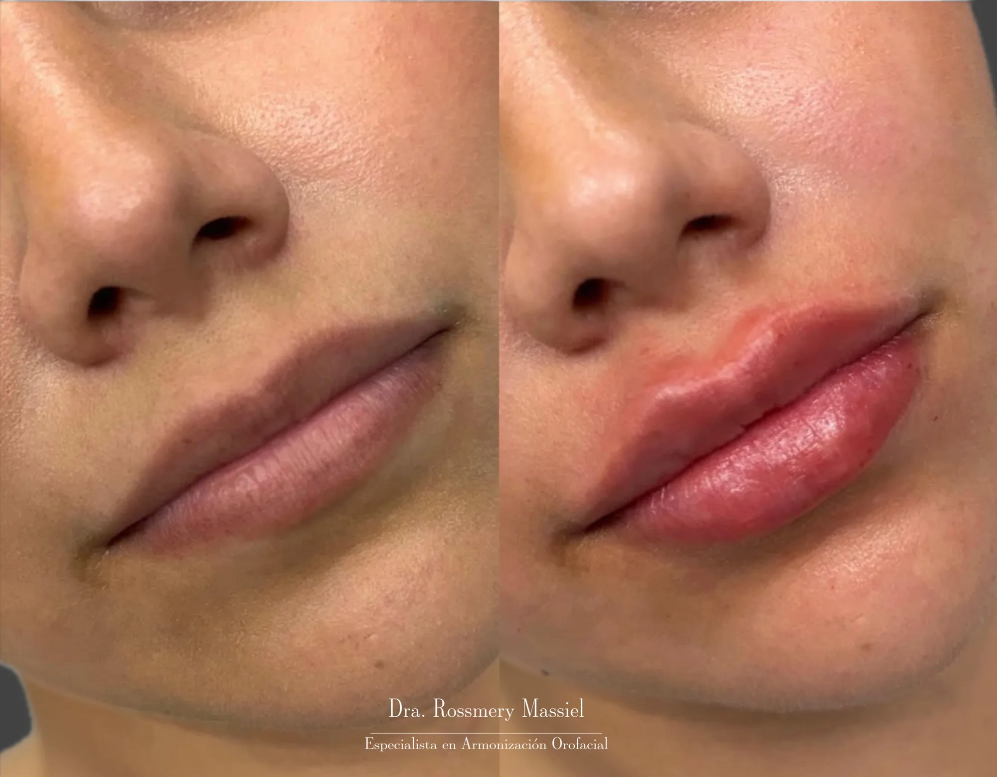 Fotografía clínica comparativa de diseño de labios