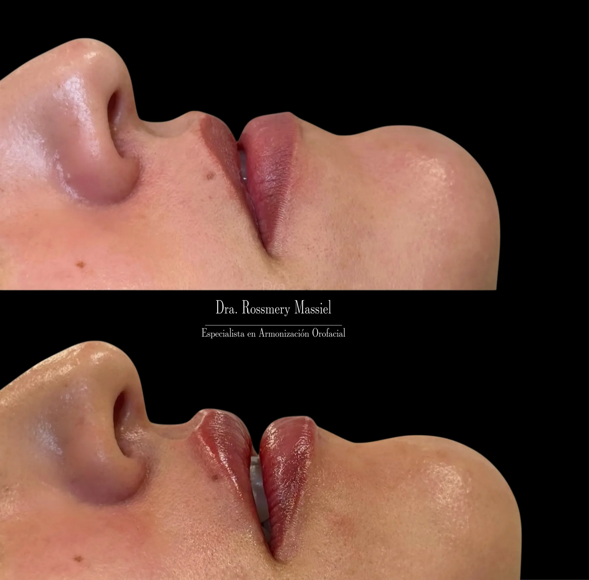 Fotografía clínica comparativa del perfil de los labios