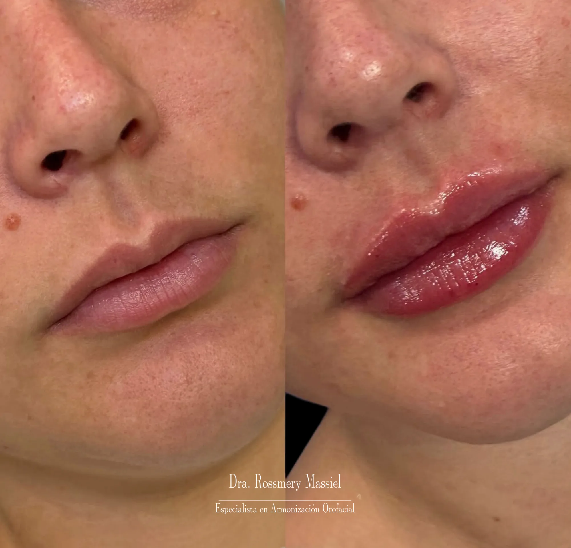 Fotografía clínica comparativa del contorno de los labios