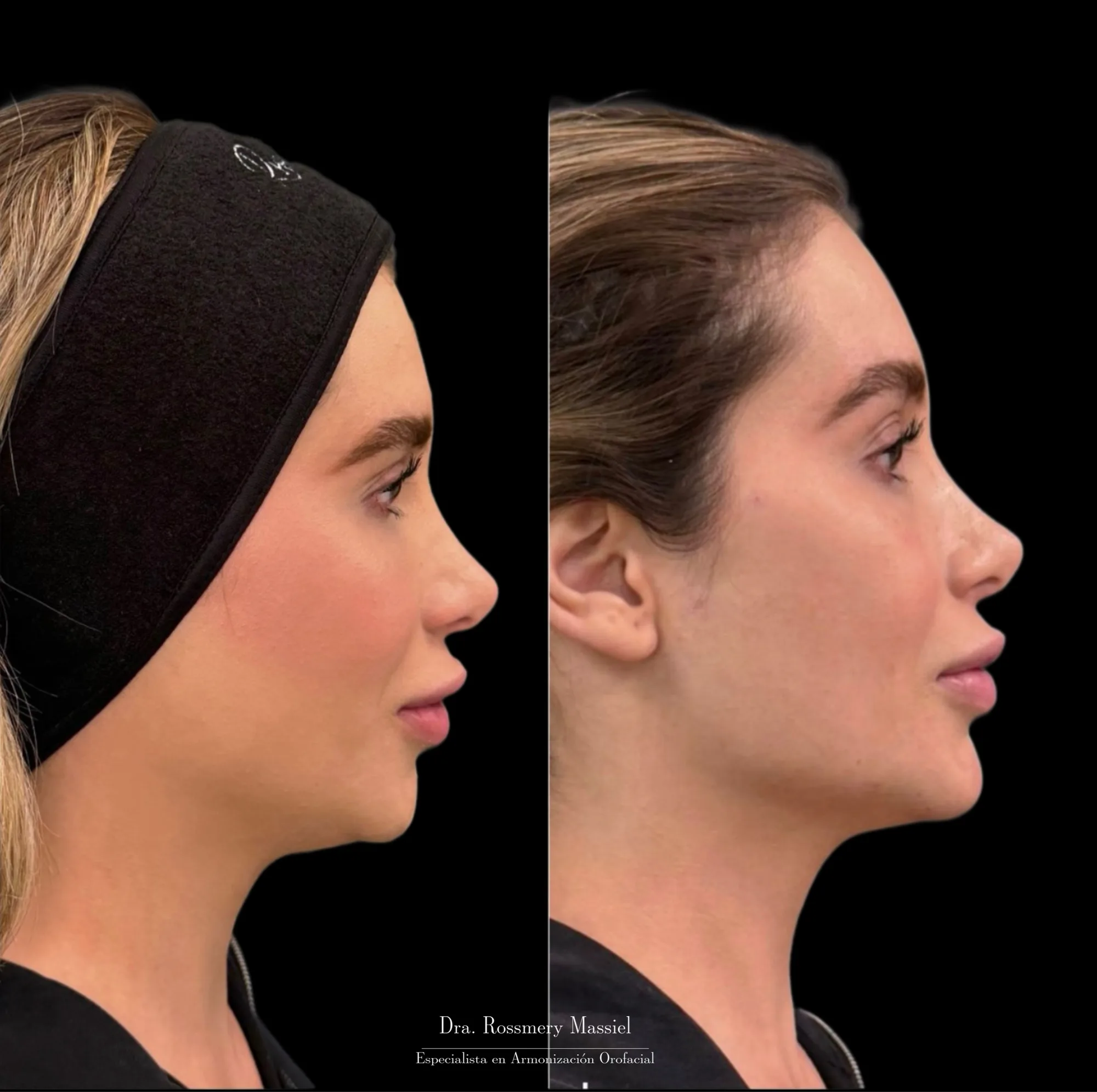 Fotografía clínica comparativa de perfiloplastia no quirúrgica
