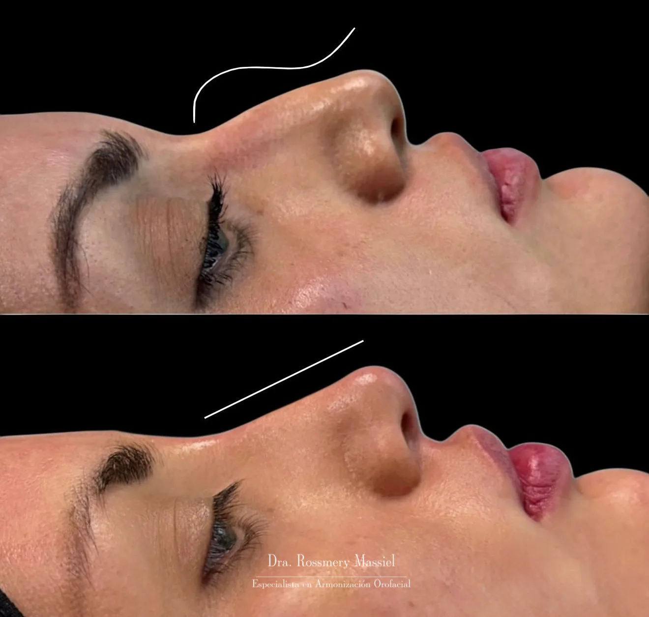 Fotografía clínica comparativa del dorso nasal en una rinomodelación