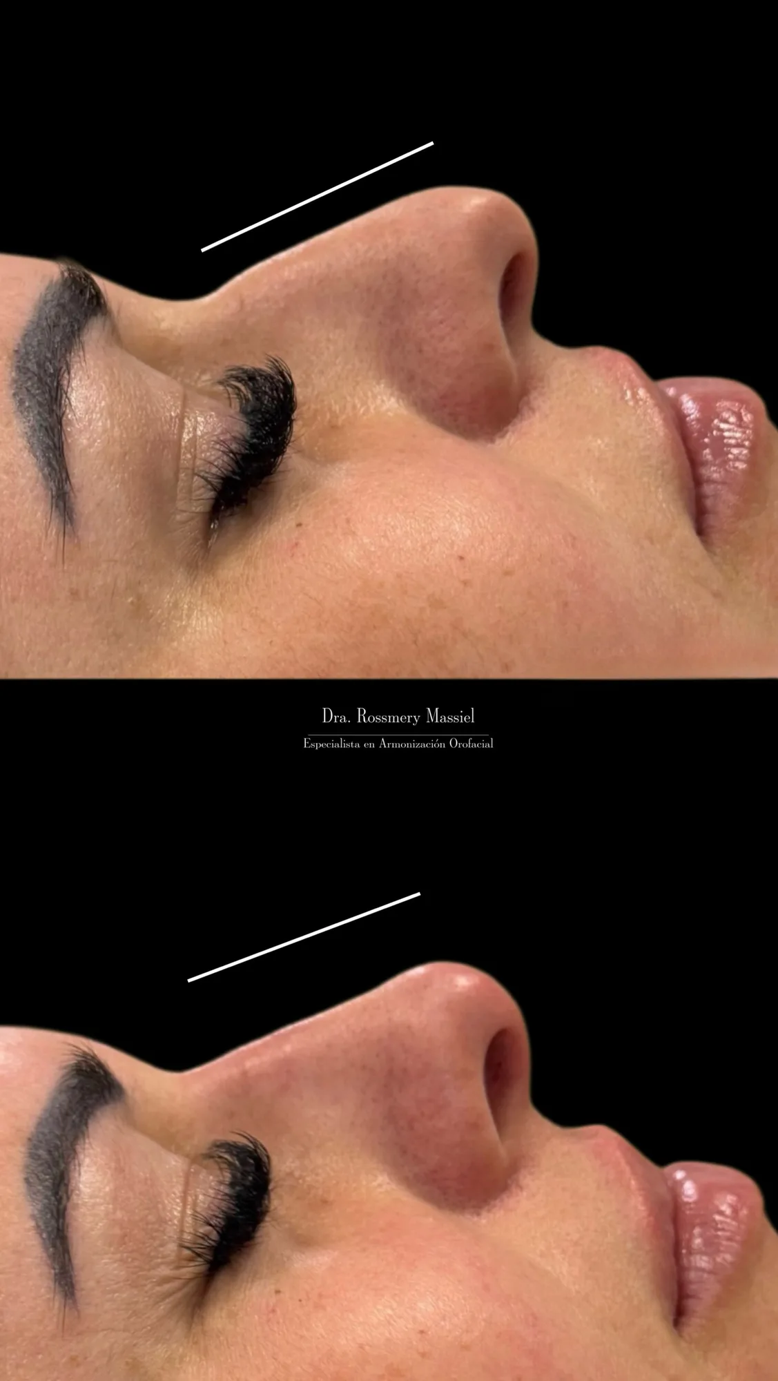Fotografía clínica comparativa de definición del perfil nasal